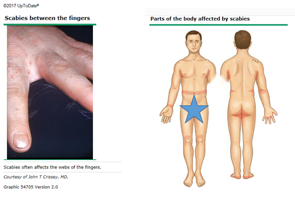 Scabies symptoms image